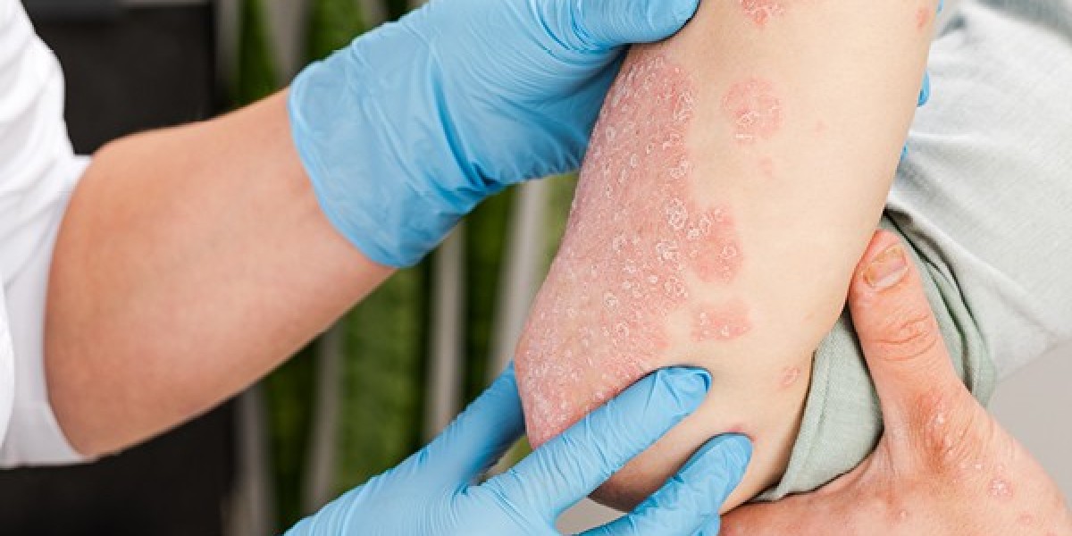 Actinic Keratosis Treatment Market | Industry Outlook Research Report 2023-2032 By Value Market Research