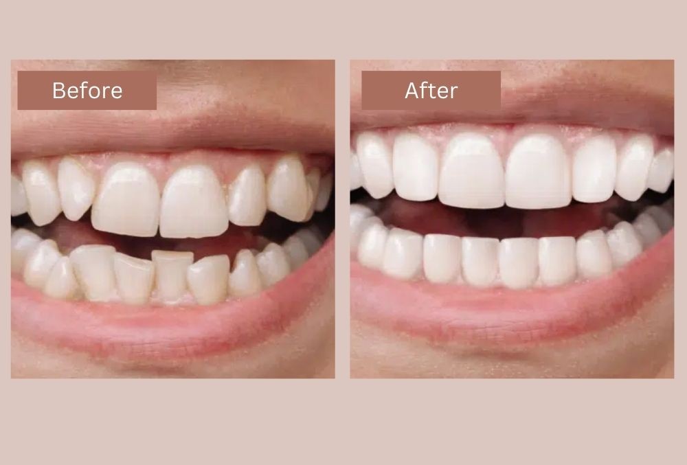 Invisalign i7 before and after