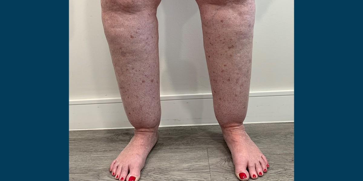 lipdema lipoclinic