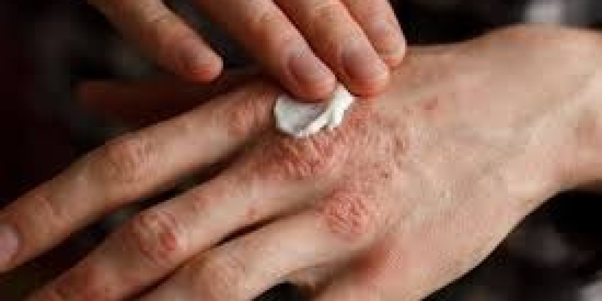 How Common Are Insect Allergies and How Prevalent Are They?