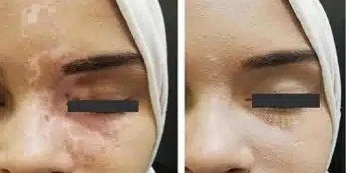 Vitiligo Camouflage Tattoo: A Life-Changing Solution to Restore Your Skin Tone
