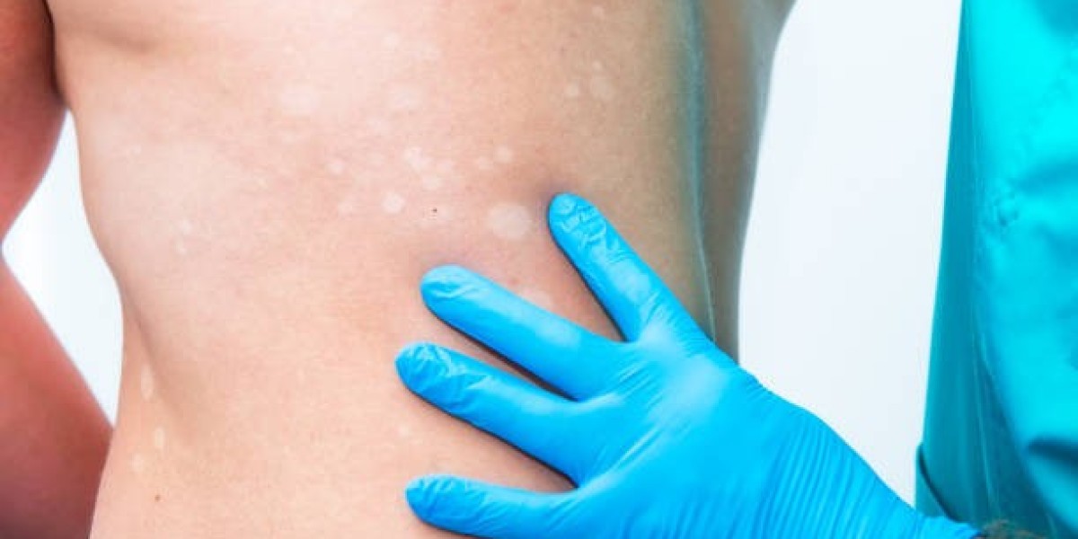 Mumbai Vitiligo Expert Treatment by Dr. Vishal Patel