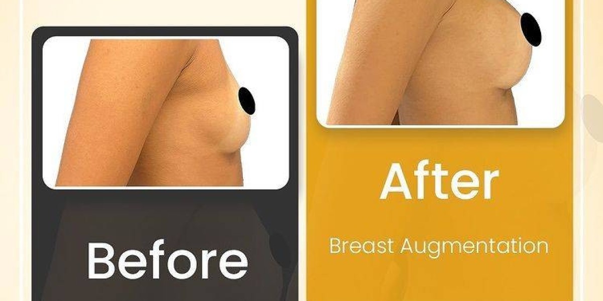 Achieve Your Dream Look with Breast Augmentation Surgery in Dubai