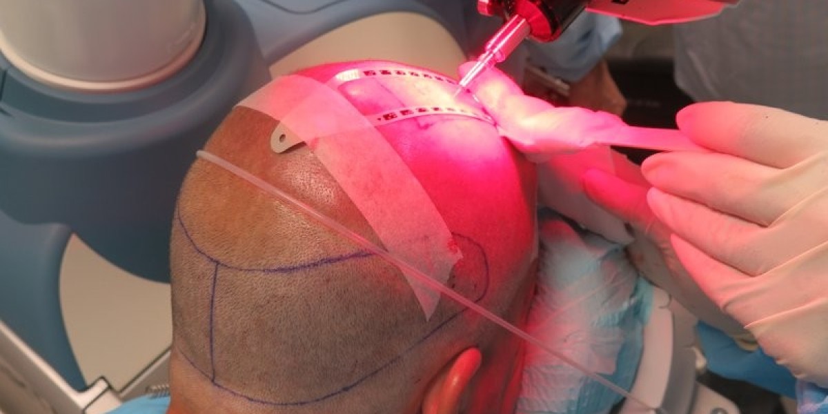 How Robotic Hair Transplants Are Revolutionizing Hair Restoration