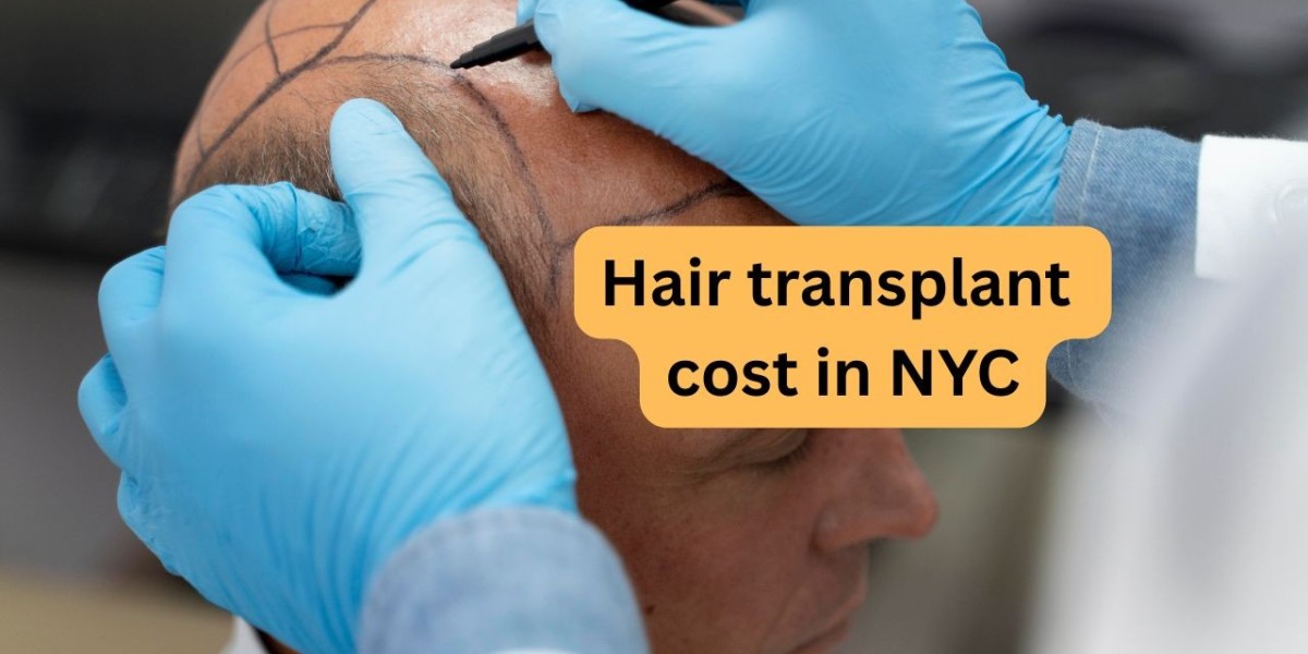 Affordable Hair Transplant Cost in NYC