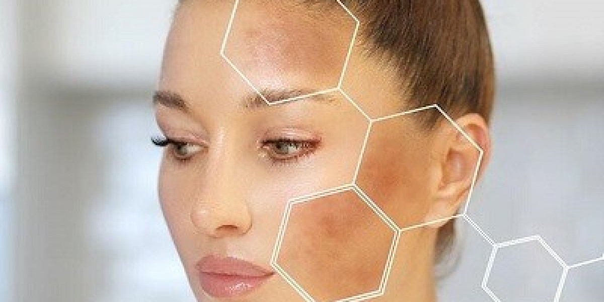 Can Melasma Come Back After Treatment? Islamabad Dermatologists Explain