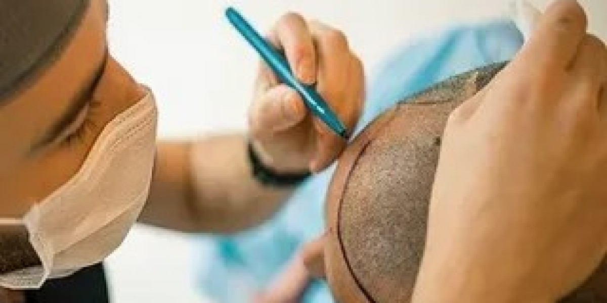 Hair Transplant for Asian Hair Types: Specialized Techniques in Islamabad