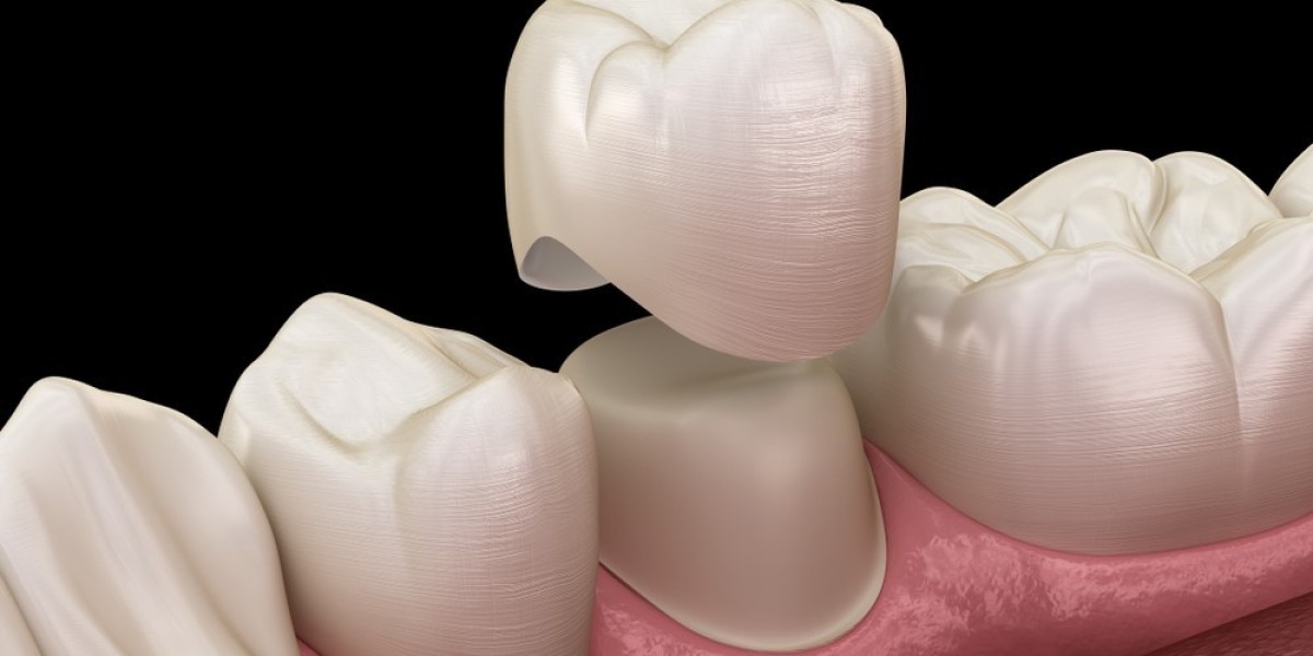 Regain Confidence with Front Teeth Crowns and Cosmetic Dentistry in Medford OR