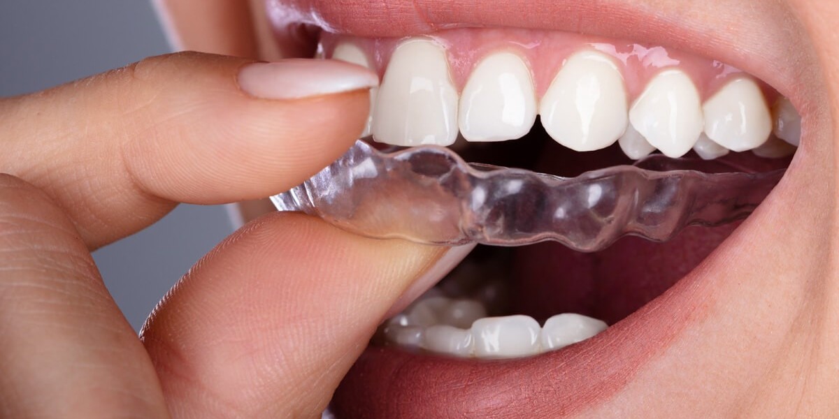 Night Guards for Teeth in Nampa, ID: Protecting Your Smile