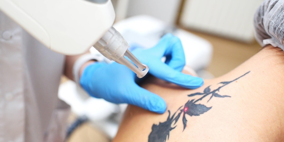 Is Laser Tattoo Removal Safe? Here’s What the Experts Say