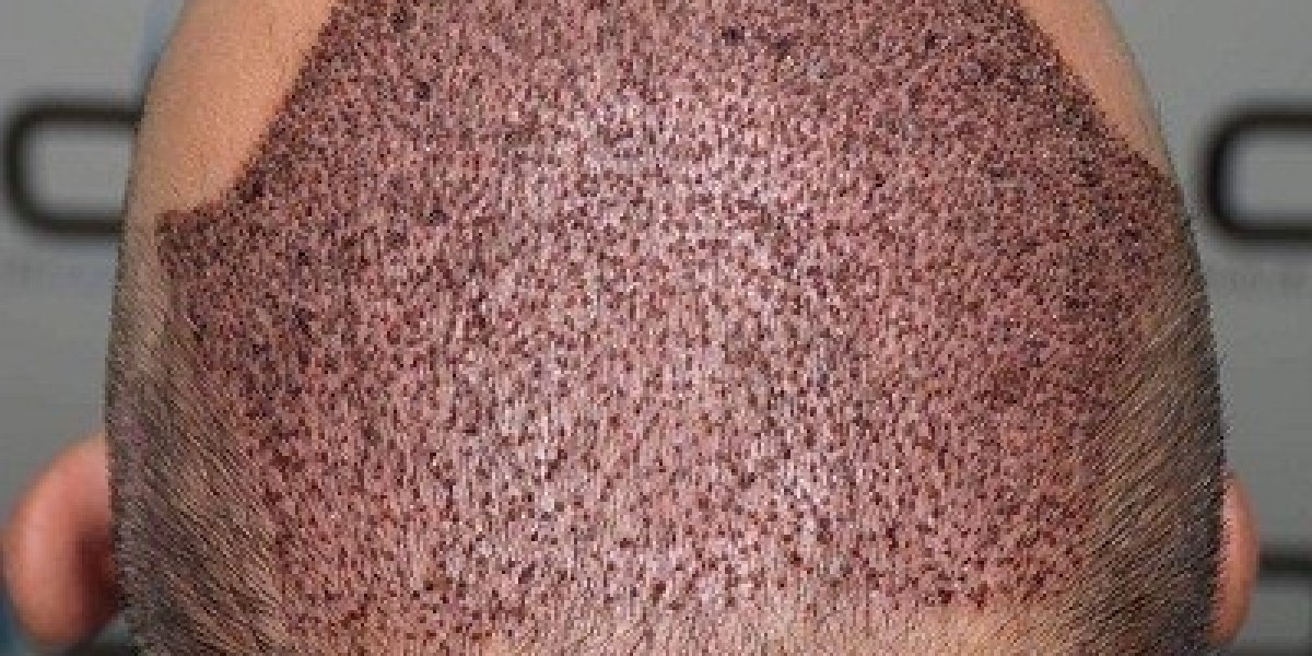 Timeline of Hair Growth After Hair Transplant in Islamabad