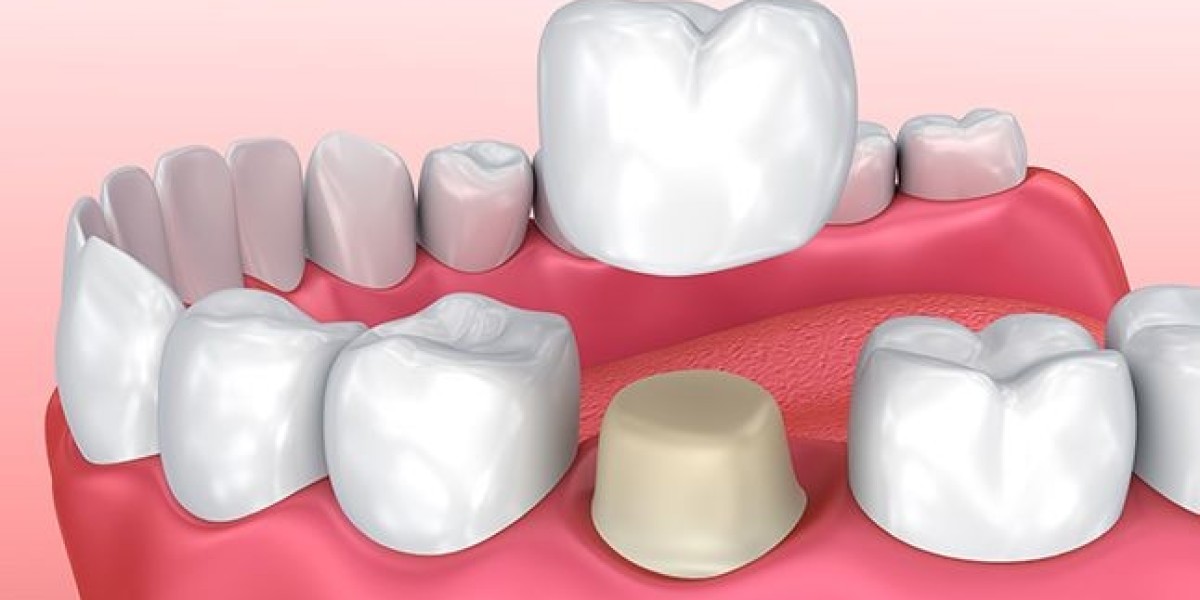 Restore Your Smile with Root Canal Tooth Crown in Nampa ID