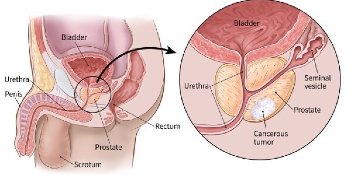 Prostate Cancer Treatment Cost in India