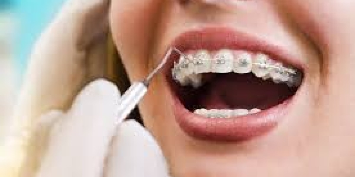 Which Types of Braces Are Right for You? Learn the Basics Here