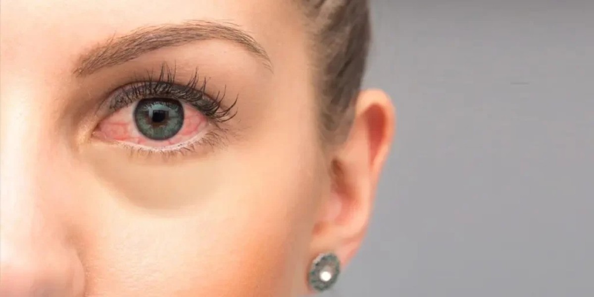How Super Specialty Eye Surgery Centers Handle Behcet's Eye Complications