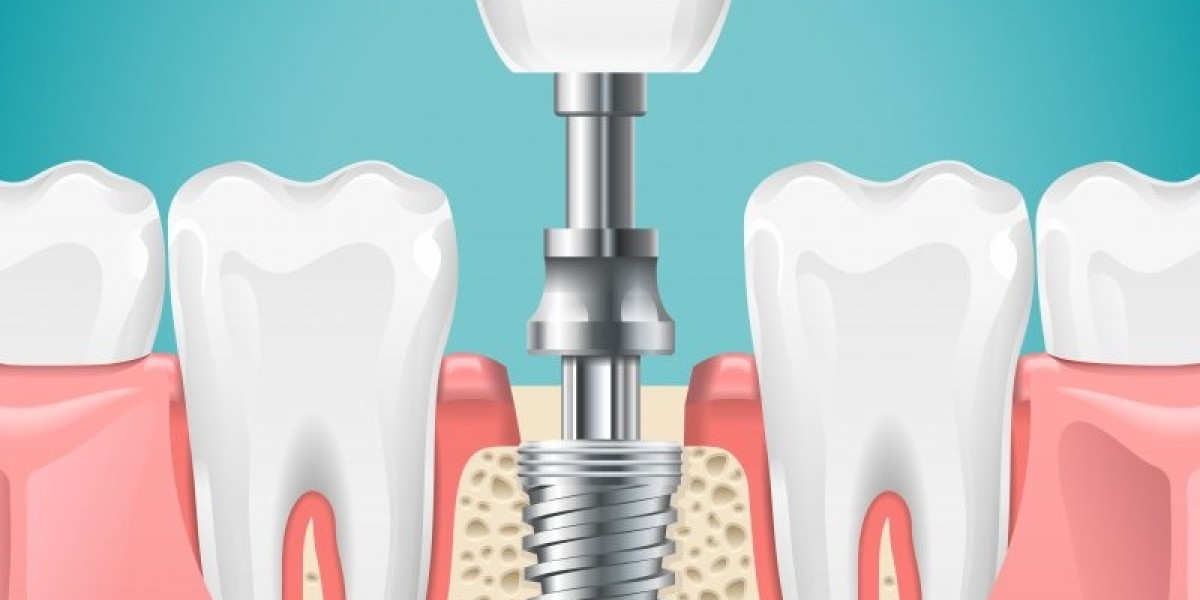 Do Dental Implants Affect Speech in Dubai Patients?