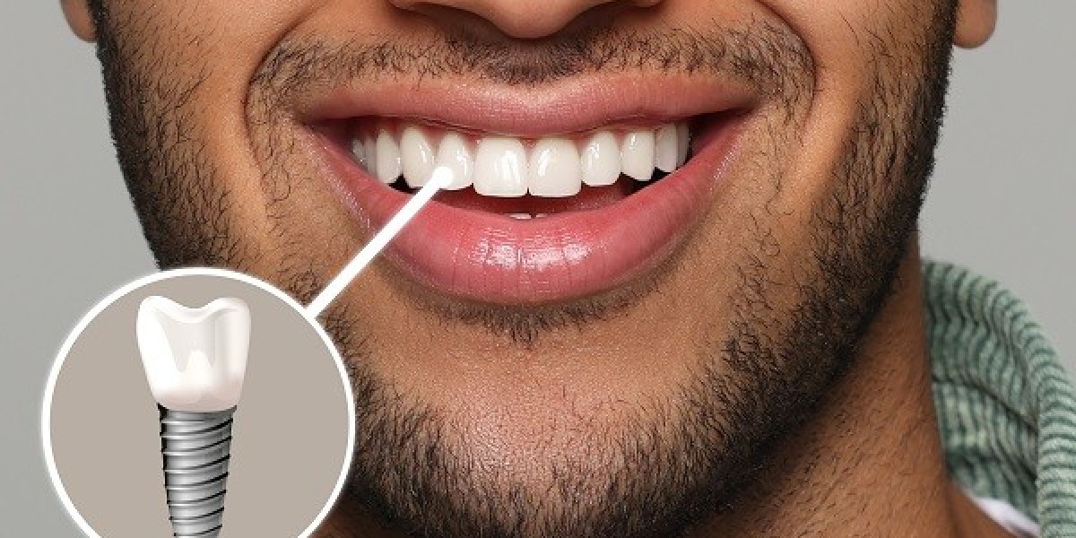 Should I Choose a Dubai Dental Implant Clinic That Offers Free Consultations?