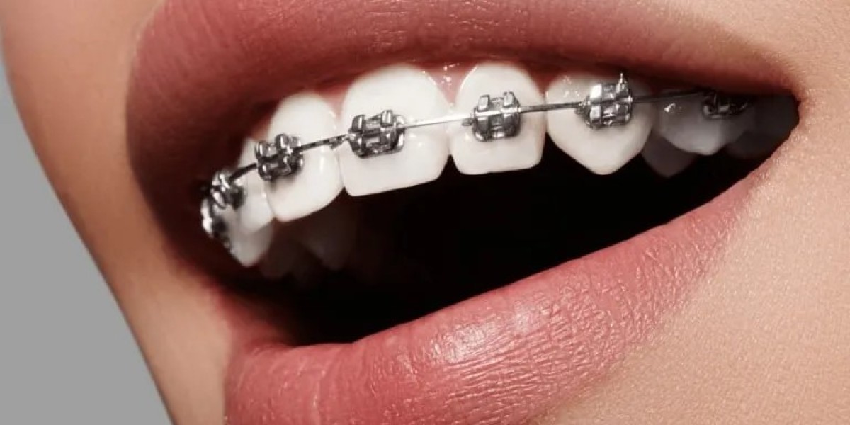 Why Are Rubber Bands Used with Braces?